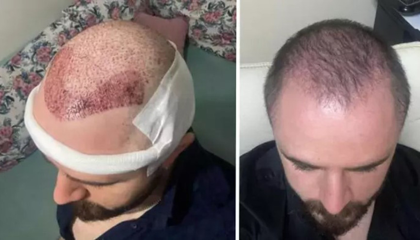 Mahkeme, avukata yapılan saç ekimini ayıplı işlem olarak kabul ederek ücret iadesine karar verdi