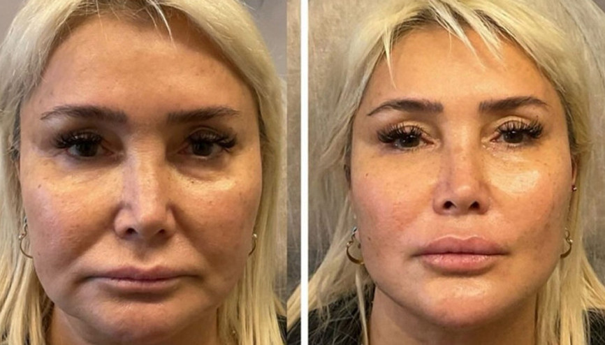 60 yaşındaki Yonca Evcimik estetik yaptırdı 30 yaş gençleşmiş