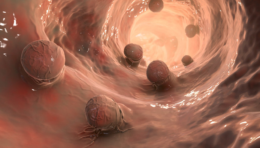 Her 5 kilo artış, riski yüzde 5 artırıyor Bu belirtileri sakın göz ardı etmeyin