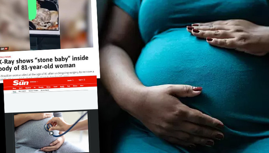56 yıl karnında taşıdığı taş bebek yüzünden hayatını kaybetti Doktorlar karın ağrısının nedeninin kanser olduğunu düşünüyordu...