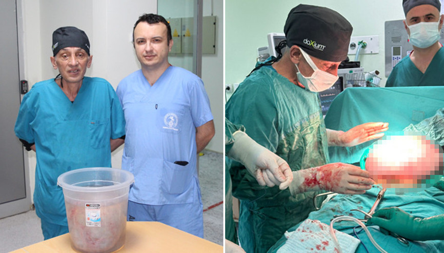 Karın ve bel ağrısı şikayetiyle hastaneye gitti Karnından 10 kilo ağırlığında tümör çıkartıldı