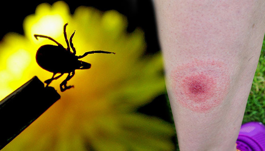 ‘Büyük taklitçi’ olarak bilinen hastalıkta umut veren gelişme İnsan terinde bulunan protein sonu olabilir… ‘Krem, ilaç ya da aşı üretilebilir’ ‘Büyük taklitçi’ olarak bilinen hastalıkta umut veren gelişme İnsan terinde bulunan protein sonu olabilir… ‘Krem, ilaç ya da aşı üretilebilir’