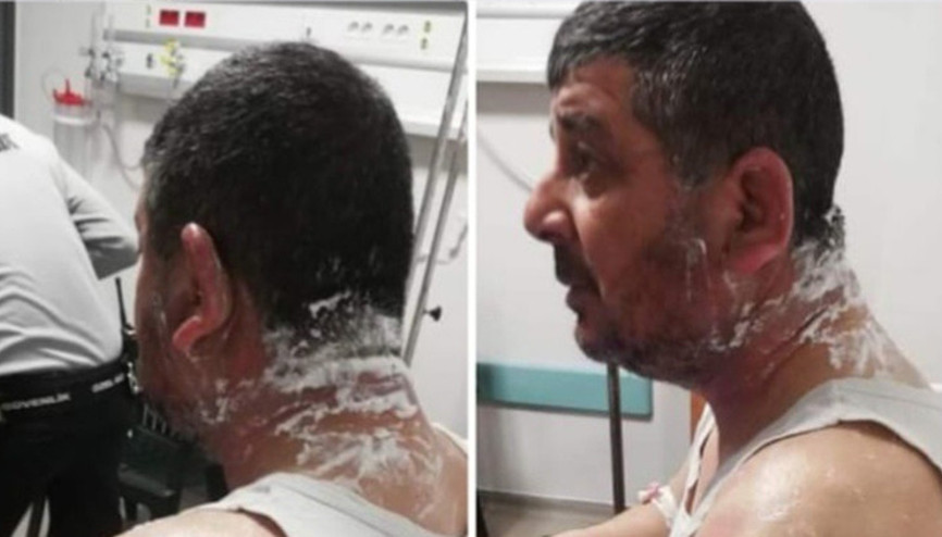 Ev sahibi tartıştığı kiracısına asitle saldırdı