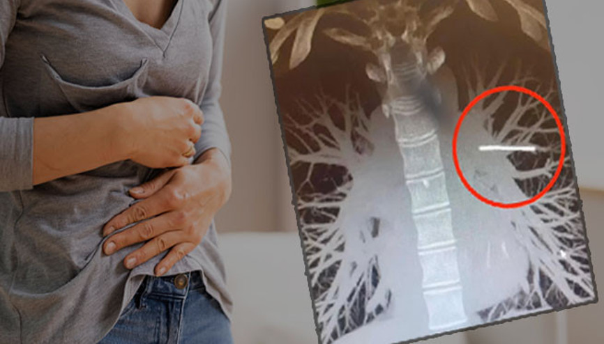 Bir yıl boyunca doğum kontrol implantının yeri bulunamadı | Sonunda akciğerlerinde olduğu tespit edildi ama çıkarılırsa ölümcül olabilir…