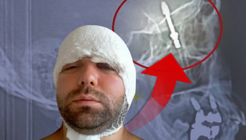 İmplant tedavisinde kan donduran olay İşlemi eliyle yapınca vida hastanın beynine saplandı... Beni hastaneye bırakıp kaçtı