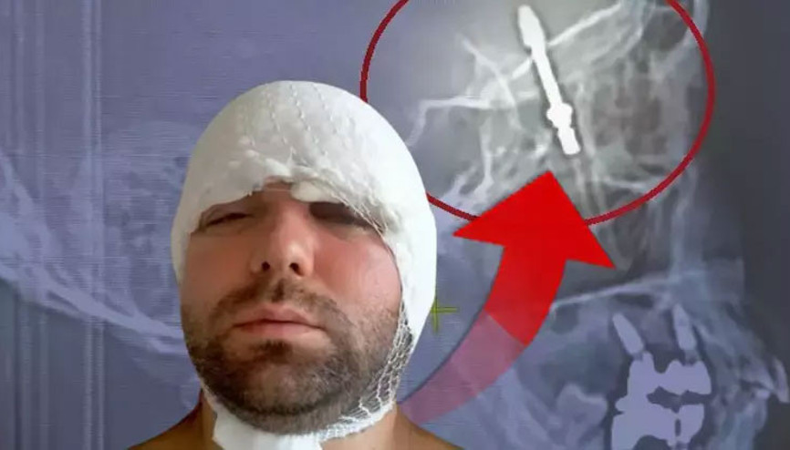 İmplant tedavisinde vida beynine saplandı