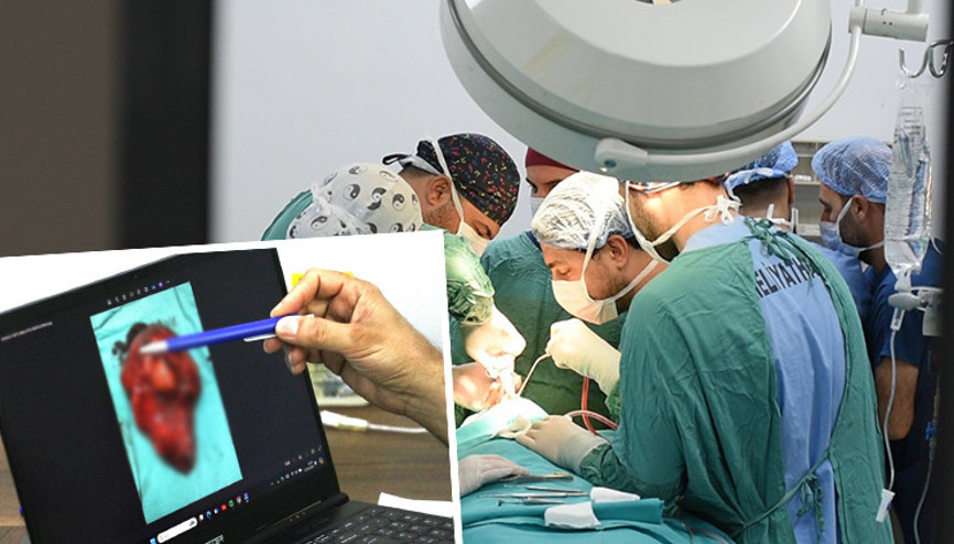 10 yıldır karın ağrısı yaşayan kadının böbreğinden çıkarıldı: Tam 3 kilo ağırlığında