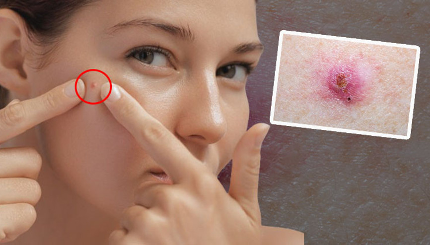 Bazal hücreli karsinom tehlikesi artıyor Basit bir sivilce olarak ortaya çıkıyor... Ülkemizde çok yaygın, sürekli kabuk bağlayan yaralara dikkat