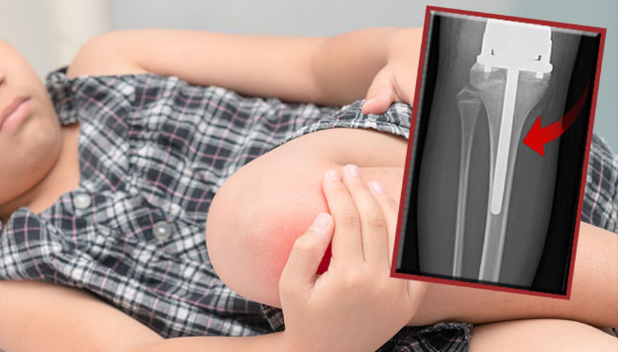 Büyüme ağrısı sandılar, bacağında 26 cm’lik bir tümör tespit edildi | Yürümeyi tekrar öğrenmek zorunda kaldı Büyüme ağrısı sandılar, bacağında 26 cm’lik bir tümör tespit edildi | Yürümeyi tekrar öğrenmek zorunda kaldı