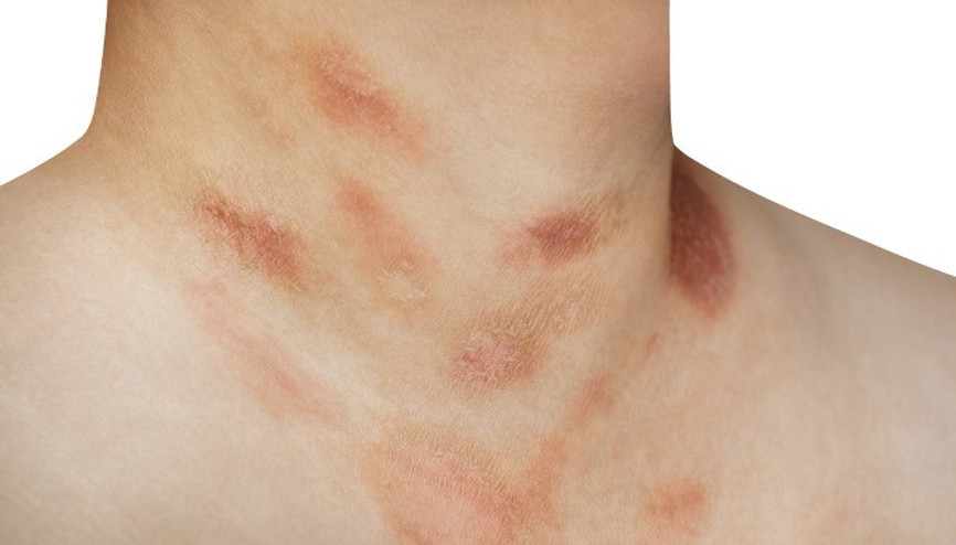 Gül Hastalığı (Rosacea) ile nasıl başa çıkılır
