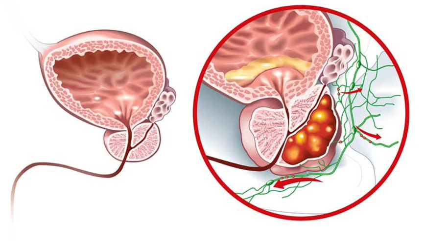Her yıl 52 bin erkeğe teşhis konuyor, 12 bini hayatını kaybediyor Her erkeğin prostat kanseri hakkında bilmesi gereken 9 hayati şey