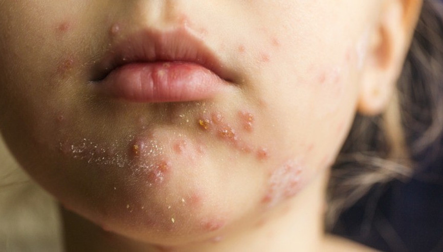 Zona (Herpes Zoster) Gece Yanığı hakkında her şey