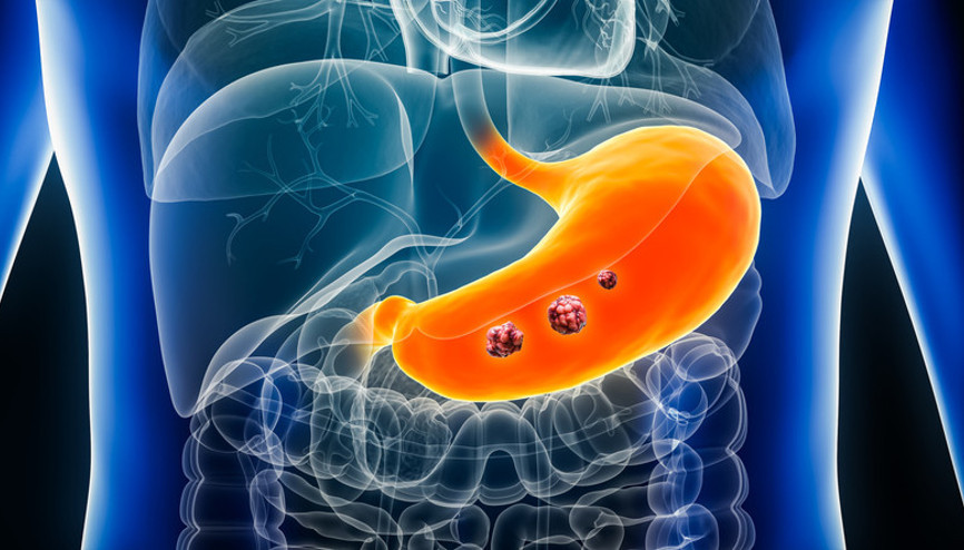 Erkeklerde daha sık rastlanıyor... Bu belirtilere çok dikkat Mide kanseri habercisi olabilir
