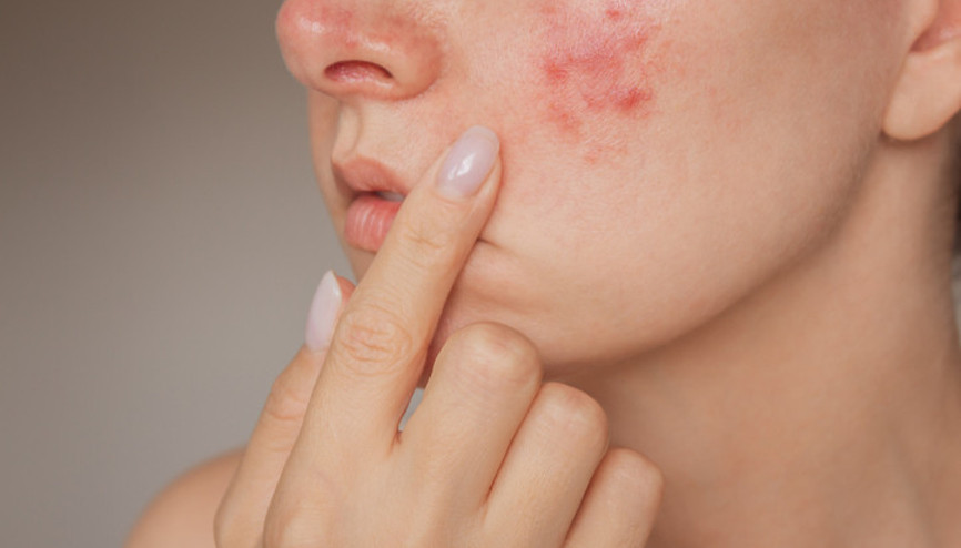 Sıcak havalarda artabiliyor... Yaz mevsiminde sivilcelerin tekrarlamaması için 10 öneri Sıcak havalarda artabiliyor... Yaz mevsiminde sivilcelerin tekrarlamaması için 10 öneri