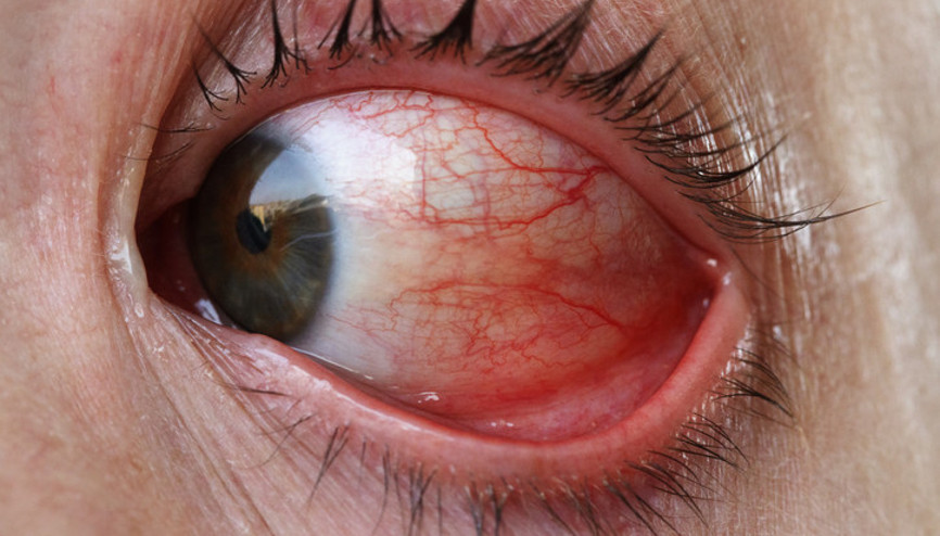 Güneş, klor ve klima göz alerjisini tetikliyor Kaşıntı, kızarıklık ve batma varsa dikkat