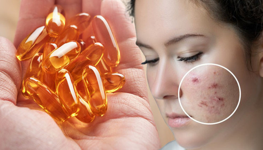 Almanyadaki araştırmanın sonuçları şaşırttı... İşte inatçı sivilceleri kökünden kurutan yöntem