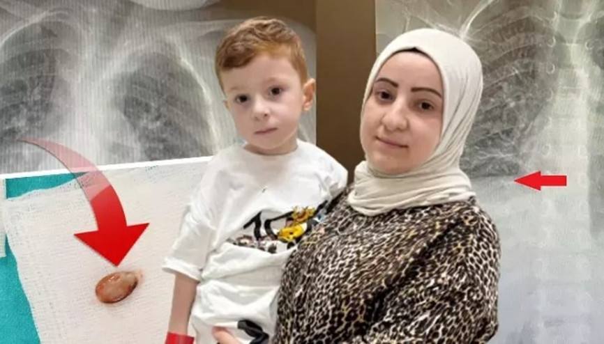 Doktorları bile şaşırtan vaka: Nefes borusundaki çekirdekle 3 yıl yaşadı