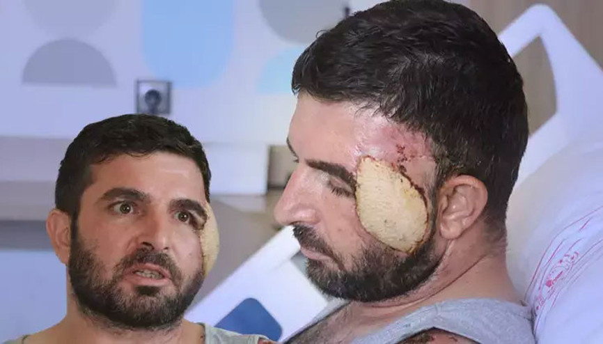 Çocuklarını kurtarmak için otomobilinin önüne atladı; yaralanan yüzüne bacağından doku nakli yapıldı Çocuklarını kurtarmak için otomobilinin önüne atladı; yaralanan yüzüne bacağından doku nakli yapıldı
