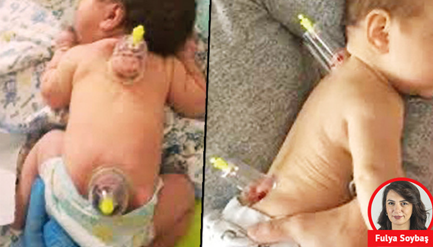 Şoka sokup ölüme götürebilir: El kadar bebeklere hacamat yapıyorlar