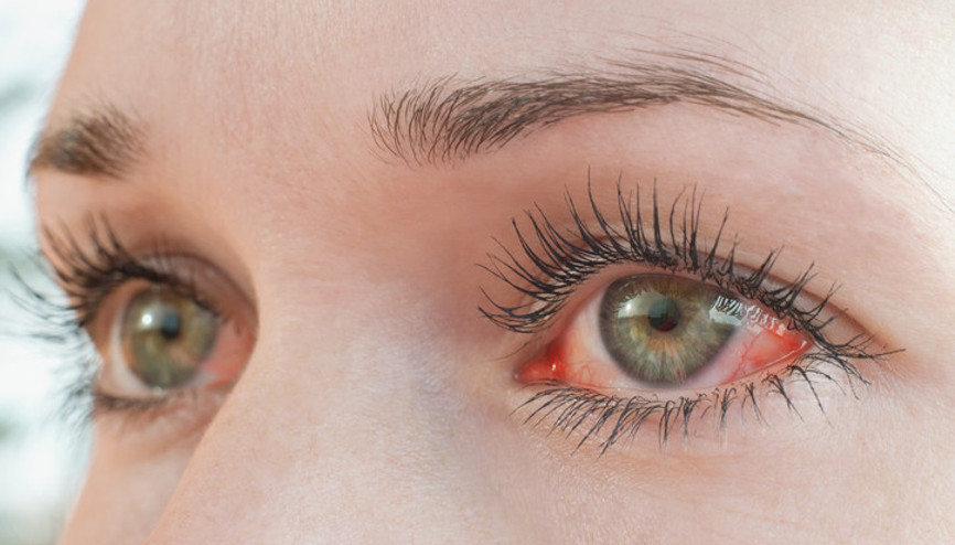 Gözünüzde kuruluk, kızarıklık, yanma ve batma varsa dikkat Göz alerjileri yaz aylarında neden artıyor