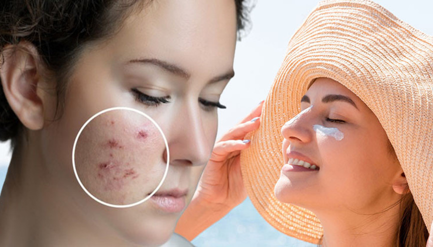 Sosyal medyadaki yeni trend şaşırttı: Sivilcesi olanlar çareyi güneş yanığında buldu ‘Böyle bir etkiden söz edilebilir ama…’