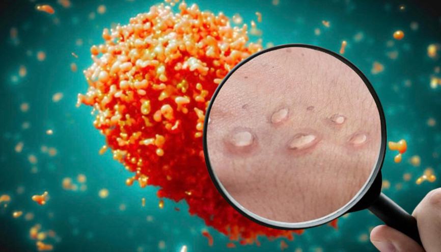 Maymun çiçeği (mpox) virüsü belirtileri nelerdir, nasıl bulaşır Maymun çiçeği Türkiyede var mı, ölümcül mü, tedavisi nedir İşte DSÖnün acil durum ilan ettiği maymun çiçeği hakkında bilgiler