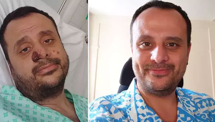 Mpox hastalığına yakalanan Harun Tulunay, yaşadıklarını anlattı