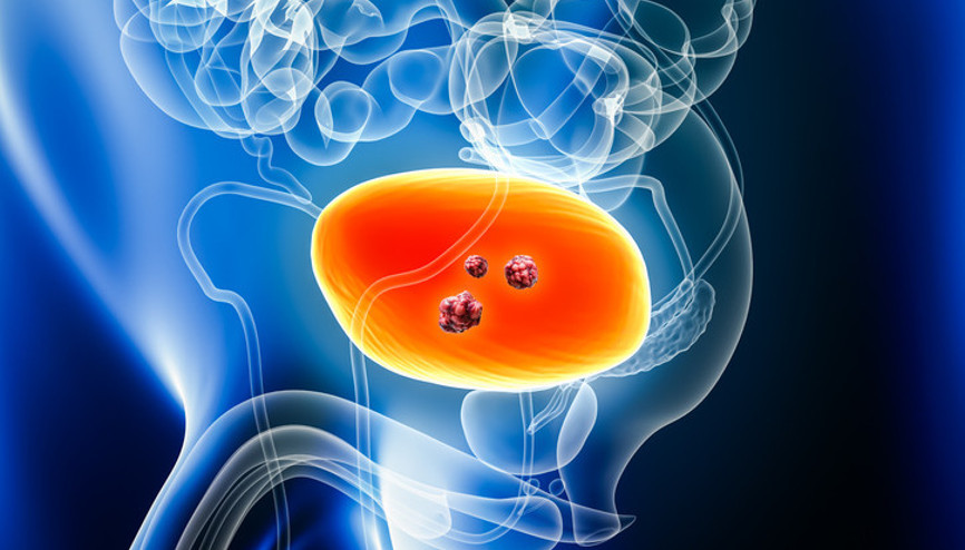 Görülme yaşı 16’ya kadar düştü Sigara kullanılan ortamlar, işlenmiş gıdalar, hile karışmış zeytinyağlar mesane tümörüne davetiye çıkarıyor