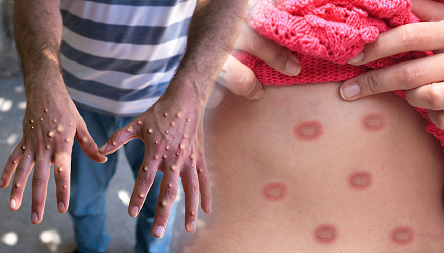 Yaşadığı semptomlar korkuttu: Dokuz gündür M-Çiçeği virüsüyle mücadele ediyor ‘O kadar ağrıyor ki uyuyamıyorum’