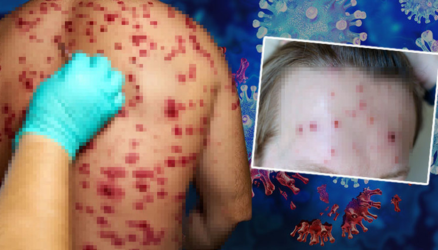 Zona vakaları artıyor Gençleri hedef almaya başladı… ‘Körlüğe neden olabilir hatta ölümcül sonuçlar doğurabilir’ Zona vakaları artıyor Gençleri hedef almaya başladı… ‘Körlüğe neden olabilir hatta ölümcül sonuçlar doğurabilir’