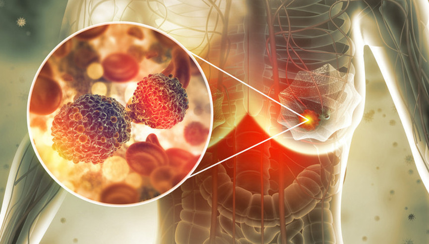 Meme kanserine karşı sebze meyveden zengin beslenin Meme kanseri tanısı için 3 kritik kural