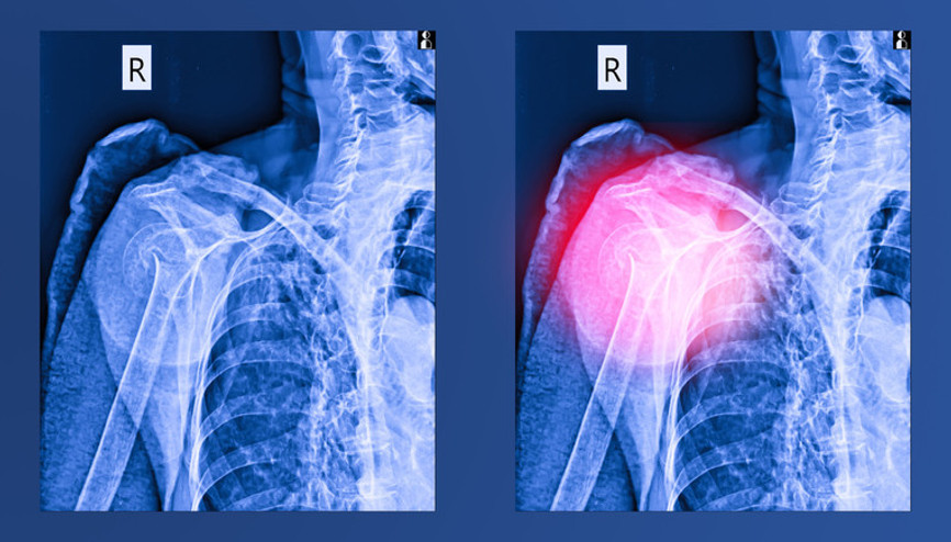 Kolu kırılmasa kemik kanseri olduğunu anlaşılmayacaktı Kolu kırılmasa kemik kanseri olduğunu anlaşılmayacaktı