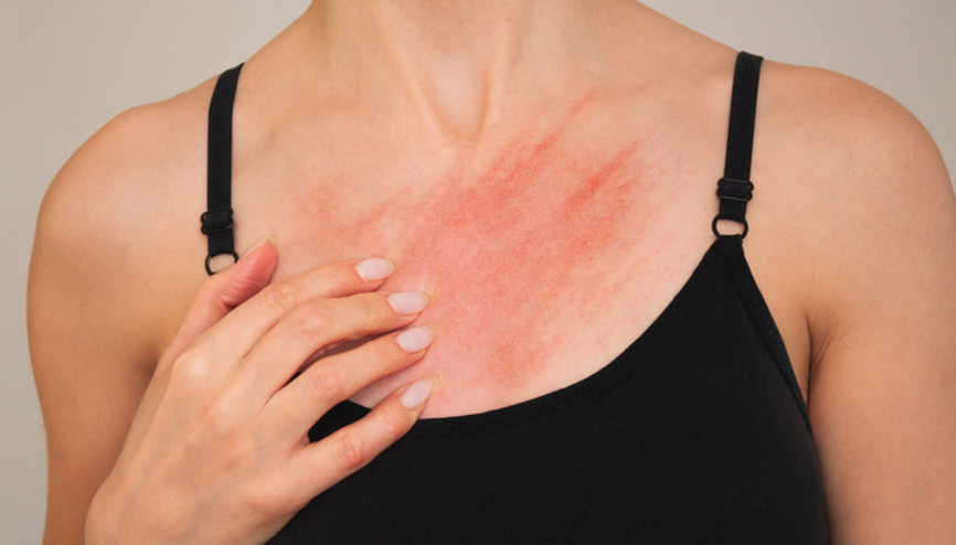 Uzmanlar uyarıyor Uyuz vakaları her geçen gün artıyor