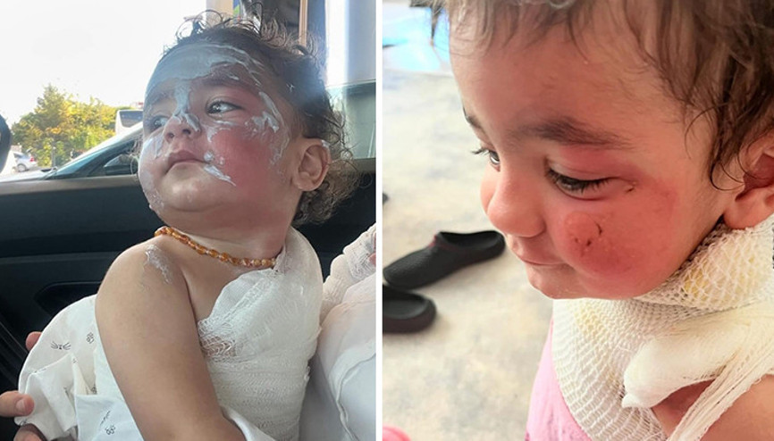 Kreş öğretmeninin ihmali 1.5 yaşındaki çocuğu yaktı: Küçük Adende ikinci derece yanık oluştu