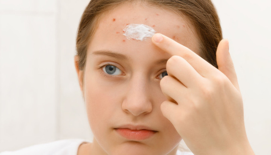 Diş macunu sivilceleri tedavi edebilir mi Aman dikkat kimyasal yanıklara neden olabilir