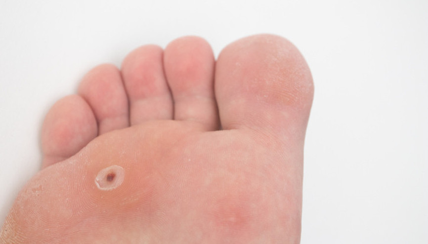 Plantar siğiller: “Her adımda küçük bir kayanın üzerinde yürümek gibi” | Çıplak ayakla dolaşmayın Plantar siğiller: “Her adımda küçük bir kayanın üzerinde yürümek gibi” | Çıplak ayakla dolaşmayın