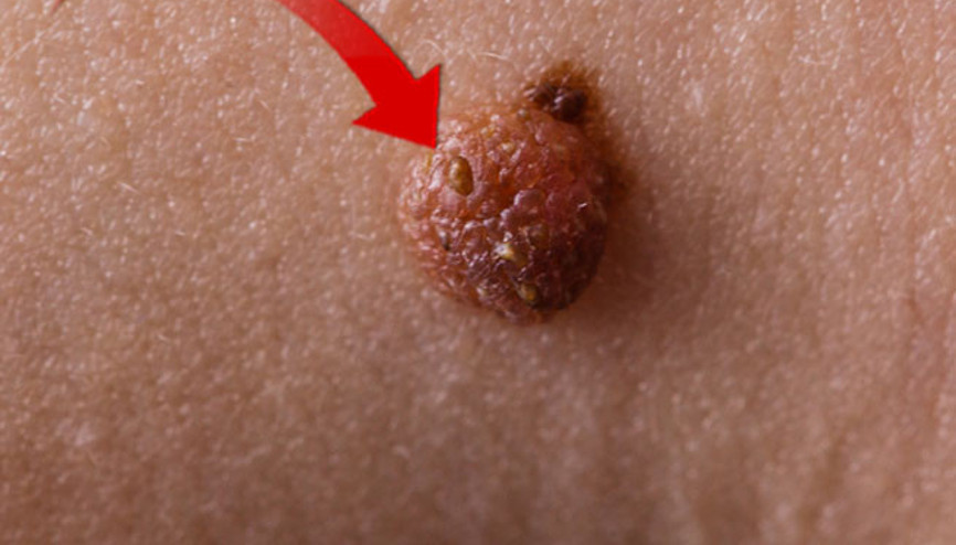 Benlerimiz bize ne söylüyor Vücuttaki ben sayısı önemli bir kriter. Renk ve şekil değiştiriyorsa dikkat…