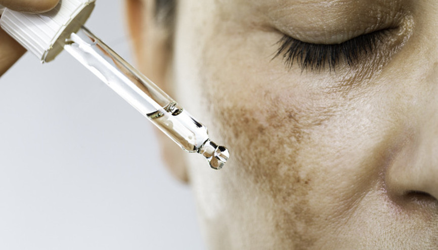 Güneş lekelerinden kurtulmak mümkün mü Evde yapılan peelingler, doğal maskeler ya da yüz masajları işe yarar mı Güneş lekelerinden kurtulmak mümkün mü Evde yapılan peelingler, doğal maskeler ya da yüz masajları işe yarar mı