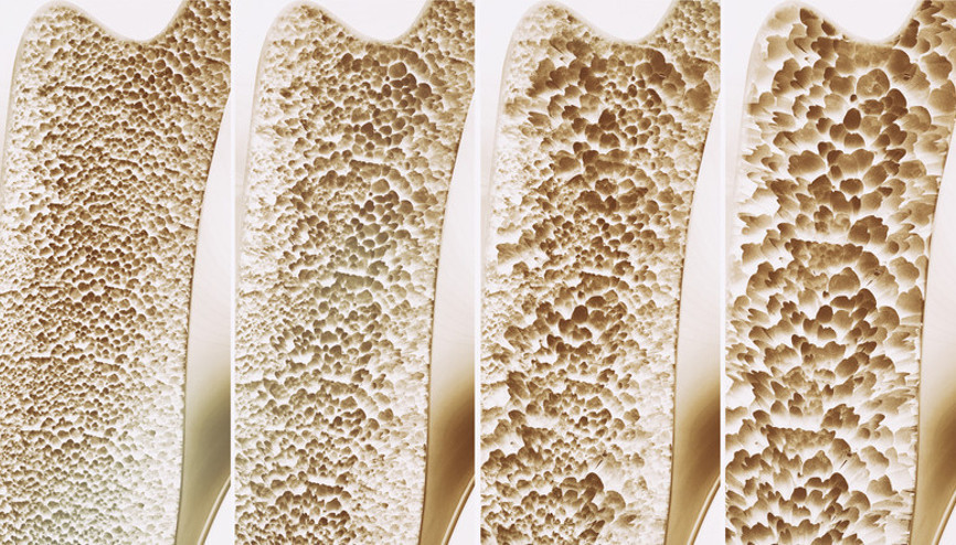 Menopoz doğal bir süreç ama kemik kaybı kader değil Osteoporoz nasıl önlenir