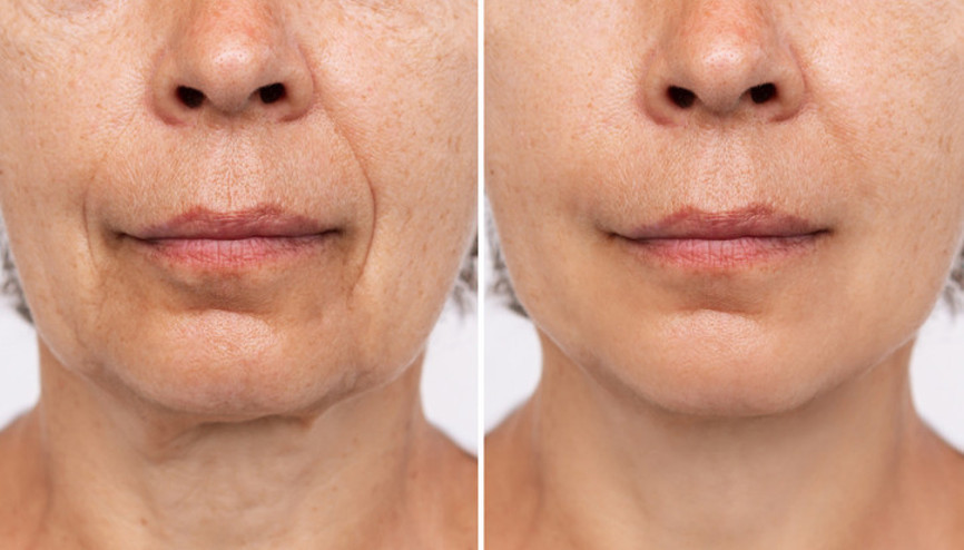 İngiliz plastik cerrah, 2024’te en çok talep edilen ‘yüzü’ açıkladı…  İnsanlar bu işlemi yaptırmak için uzmanlara akın ediyor