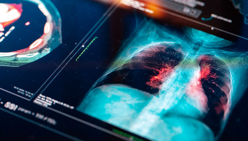 Tüm dünyada en sık rastalan kanser türü| Genellikle sessiz ilerliyor ama akciğer kanserinde cerrahi yöntem hayat kurtarıyor Tüm dünyada en sık rastalan kanser türü| Genellikle sessiz ilerliyor ama akciğer kanserinde cerrahi yöntem hayat kurtarıyor
