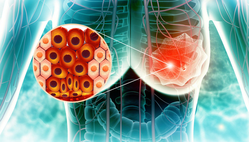 Meme kanseri hakkında en çok merak edilen 5 soru