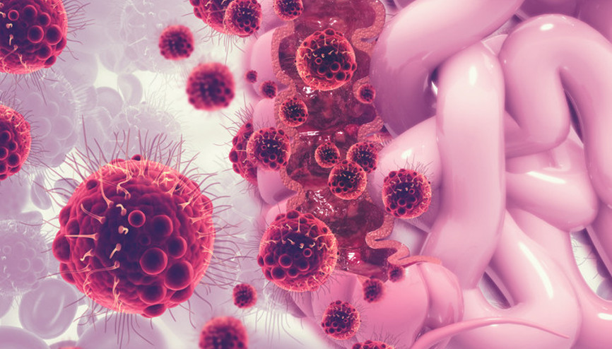 Her şey 1960larda başladı Türkiye listede 9uncu sırada... Kolon kanseri bilmecesi çözülebilecek mi Bu beş faktör çok önemli