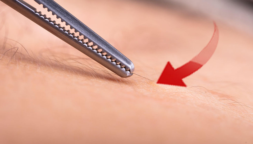 Koltukaltı ve kasık en riskli bölgeler Hayati tehlike doğuruyor