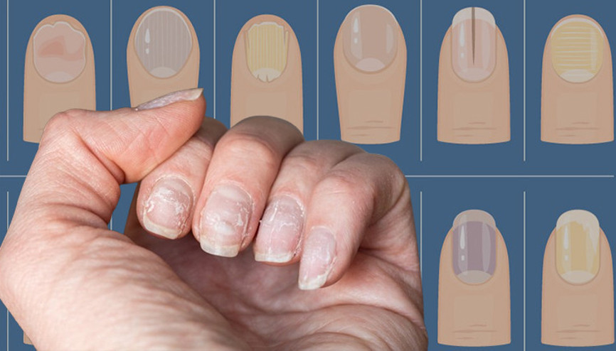Uzmanı açıkladı: Tırnaklardaki renk ve şekil bozuklukları ciddi hastalıkların habercisi ‘Biyolojik yaşımız hakkında bile bilgiler veriyor’
