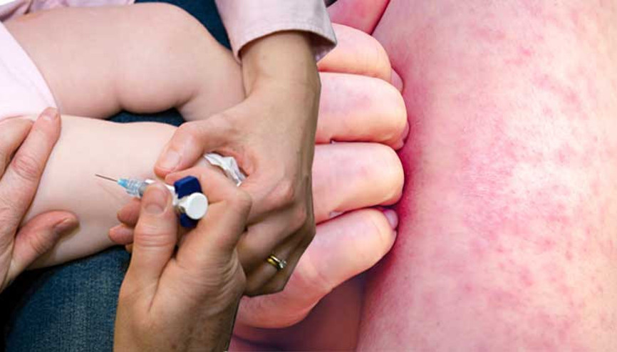 Kızamık vakaları her geçen gün artıyor, aşılama oranları ise düşüyor Türkiye’de durum ne Kızamık yeni bir pandemiye neden olur mu