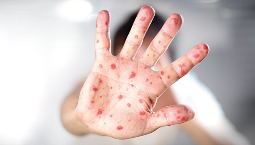 Her 3 kişiden 1’i zona oluyor