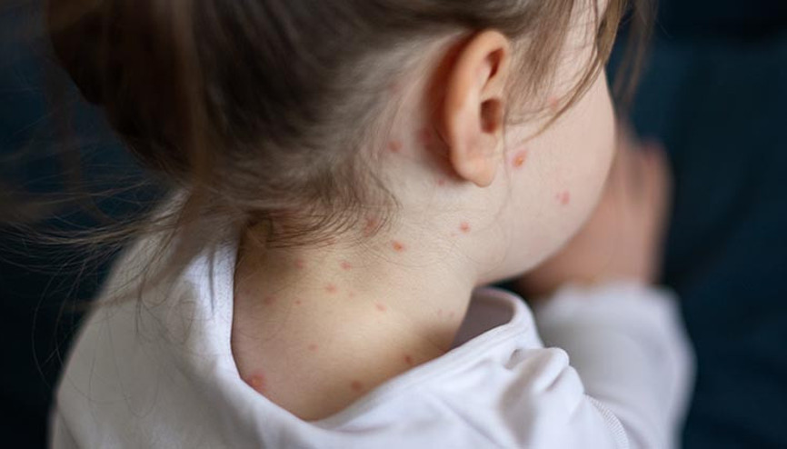 ABDde 10 yıl sonra bir ilk: Kızamık ölümü gerçekleşti