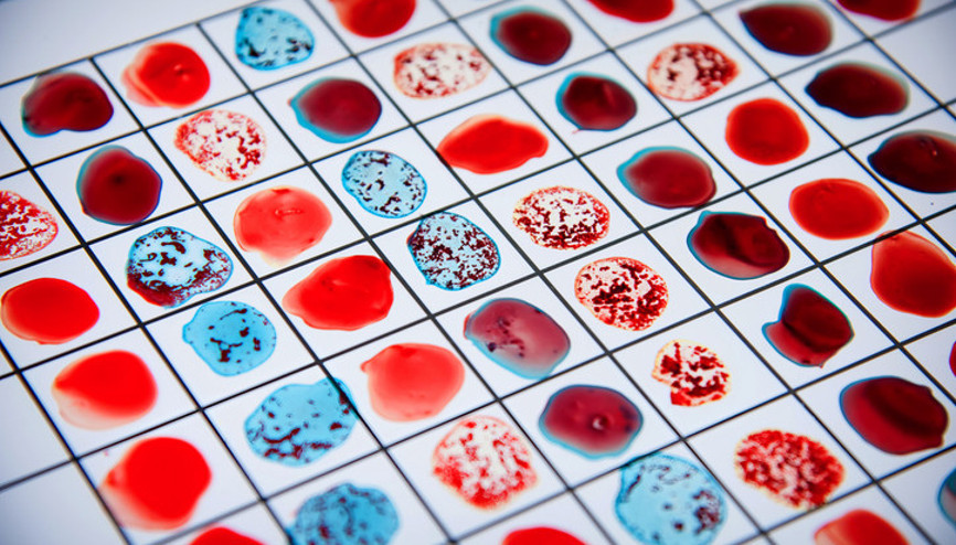 Kan grubunuz felç riskinizi etkileyebilir ‘65 yaş ve üzerini etkiliyordu ama gençlerde artmaya başladı’