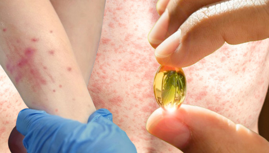 Kızamık vakaları artmaya başladı: A vitamini çözüm mü sunuyor Araştırma sonuçları kafaları karıştırdı…